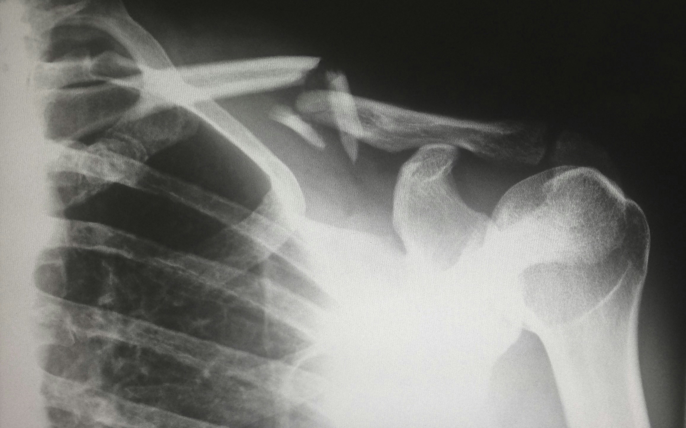 The Thrower’s Shoulder (Part 2): A Few of the Main Biomechanical Factors to Know